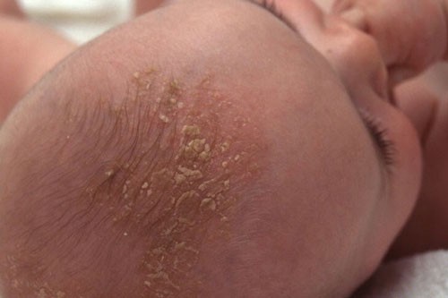 Các bệnh thường gặp ở trẻ sơ sinh