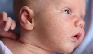 Tổng hợp các bệnh ngoài da ở trẻ sơ sinh